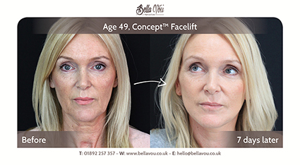 Bella Vou Concept Facelift before and after